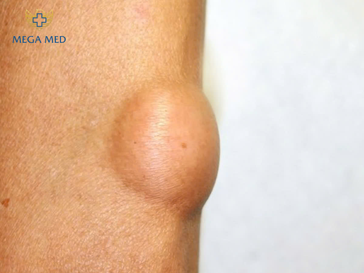 Khi nào cần cắt bỏ U mỡ